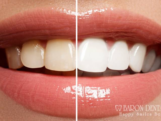 Laser Teeth Whitening in Antalya 