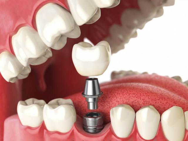 Dental Implants in Antalya