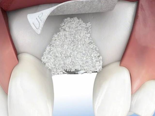 Bone Grafting in Antalya